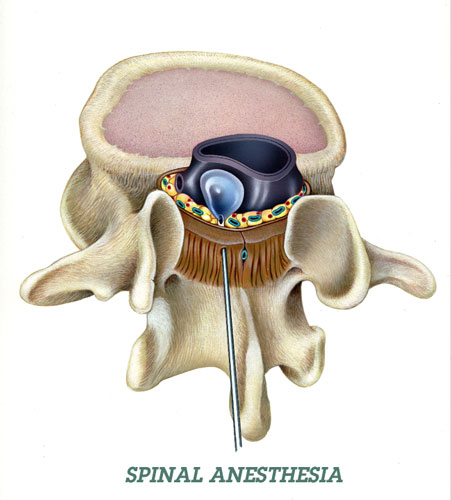 Medical Illustration - Spinal Anesthesia